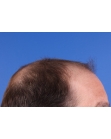 Before Hair Transplant&nbsp;2 Sessions (Areas)